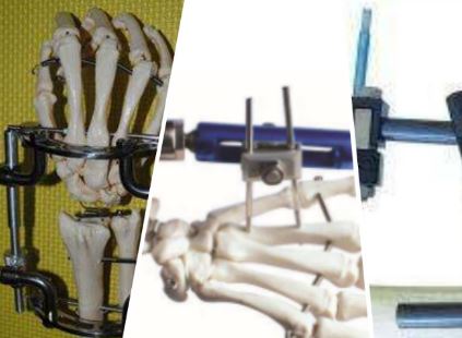 PEEK Orthopedic external fixator (1).png