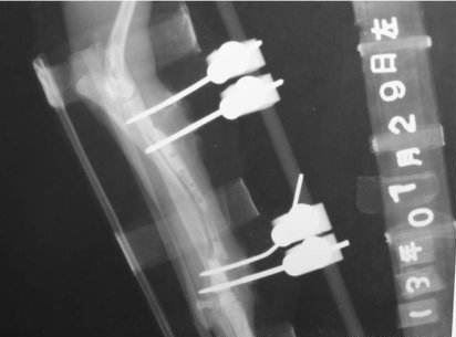 Traditional bone external fixators
