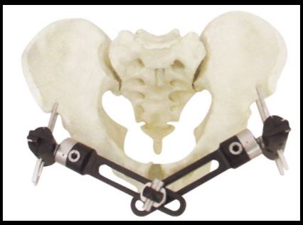 PEEK Carbon Fiber Bone External Fixator bracket